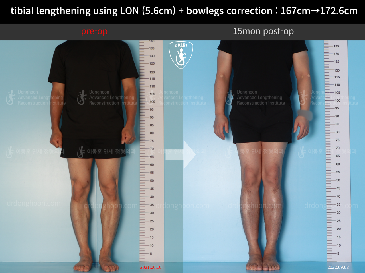 Before and after cll + deformity correction, case 12804946, image 1, Dr. Donghoon institute (DALRI)