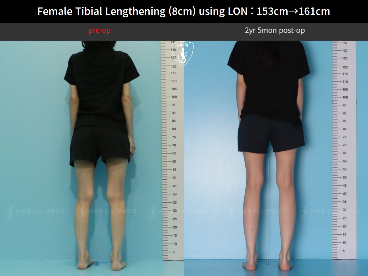 Before and after cll lon, case 128135191, image 4, Dr. Donghoon institute (DALRI)