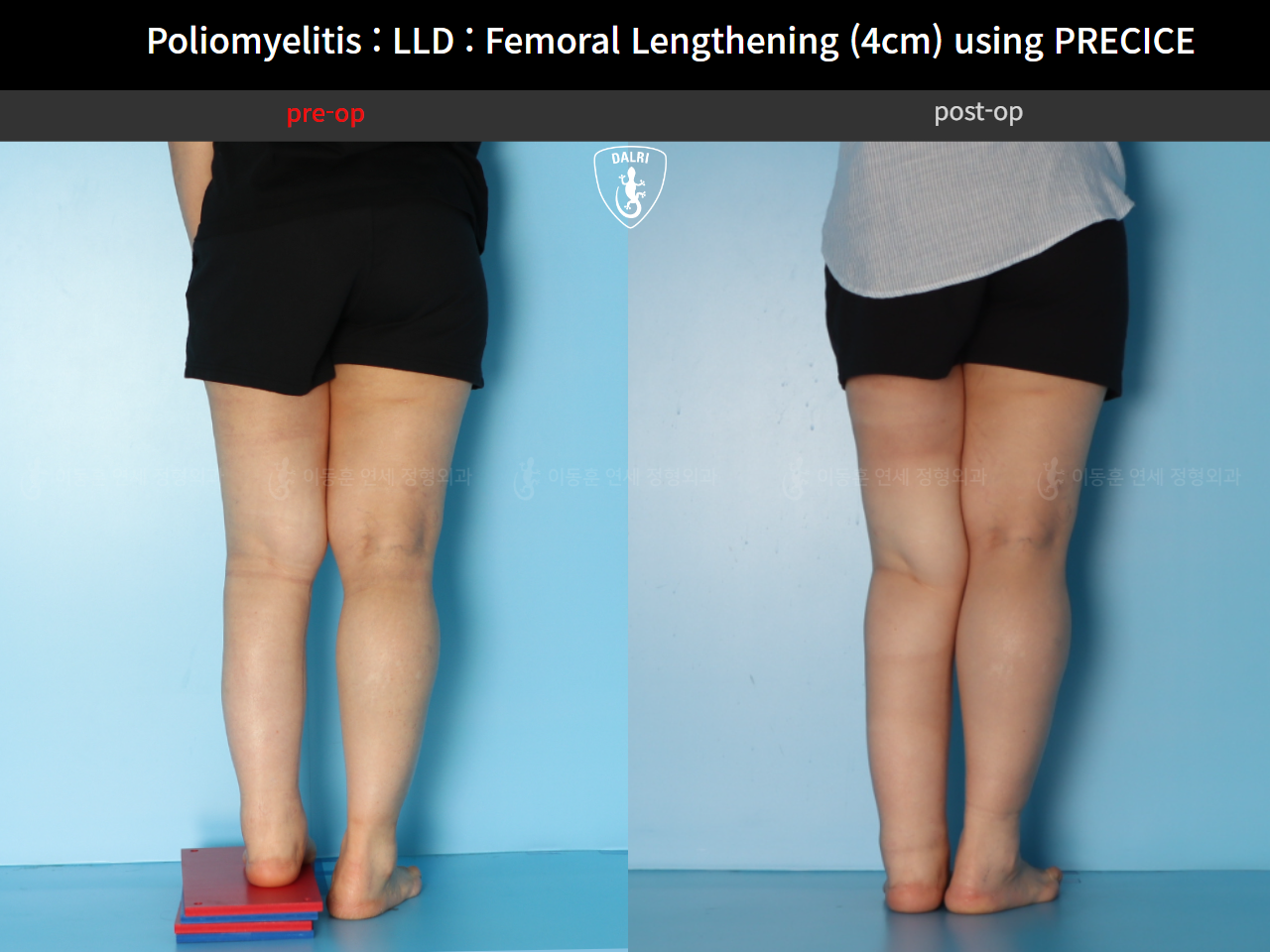 Before and after congenital condition, case 91244014, image 5, Dr. Donghoon institute (DALRI)