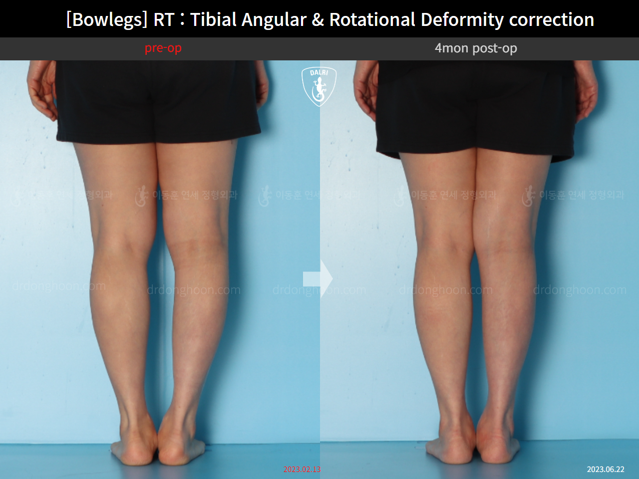 Before and after adult bowlegs, case 15741874, image 9, Dr. Donghoon institute (DALRI)