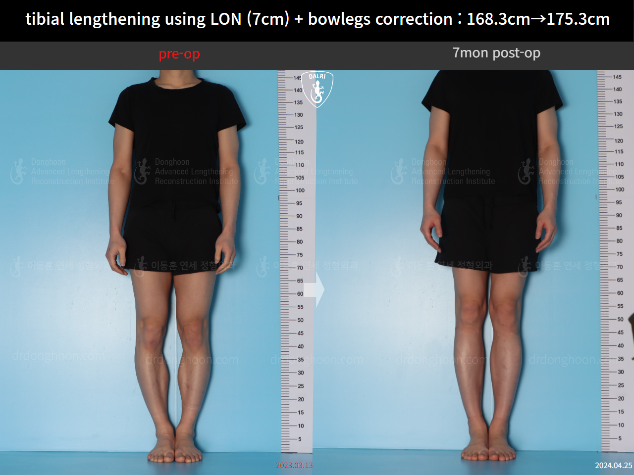 Before and after cll + deformity correction, case 21918246, image 1, Dr. Donghoon institute (DALRI)