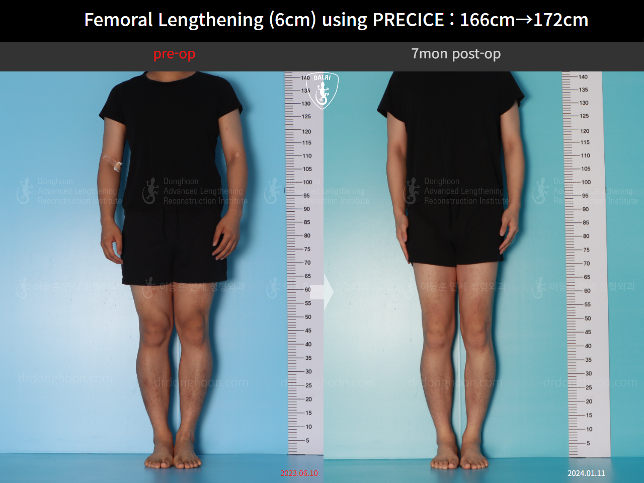 Before and after cll precice, case 17579263, image 1, Dr. Donghoon institute (DALRI)
