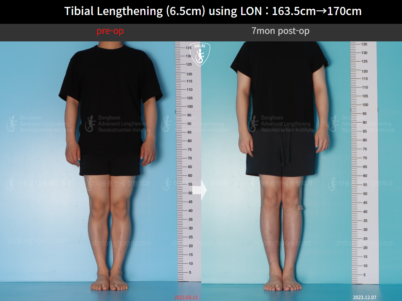 Before and after cll lon, case 17199046, image 1, Dr. Donghoon institute (DALRI)