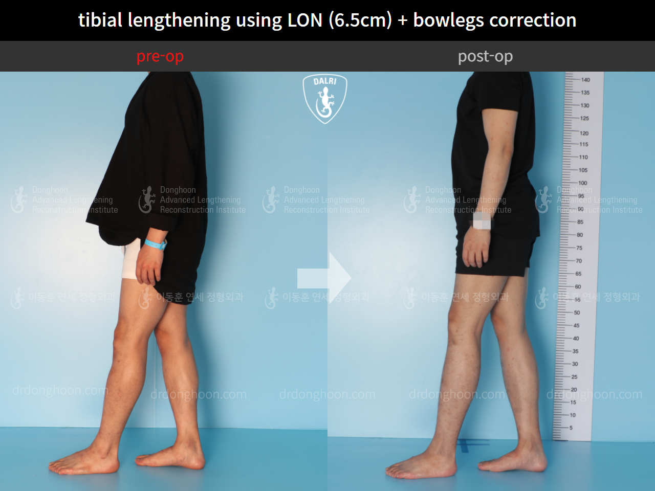 Before and after cll + deformity correction, case 4585639, image 3, Dr. Donghoon institute (DALRI)