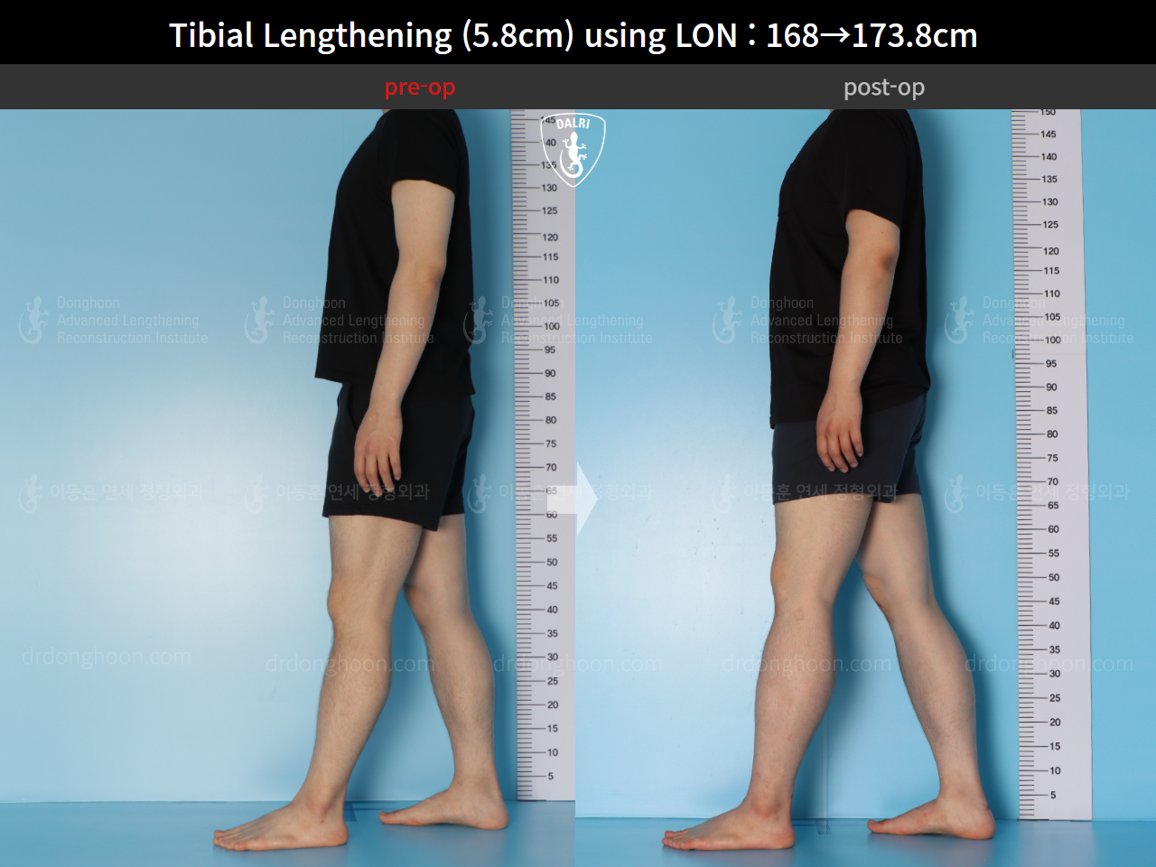 Before and after cll lon, case 15625788, image 4, Dr. Donghoon institute (DALRI)