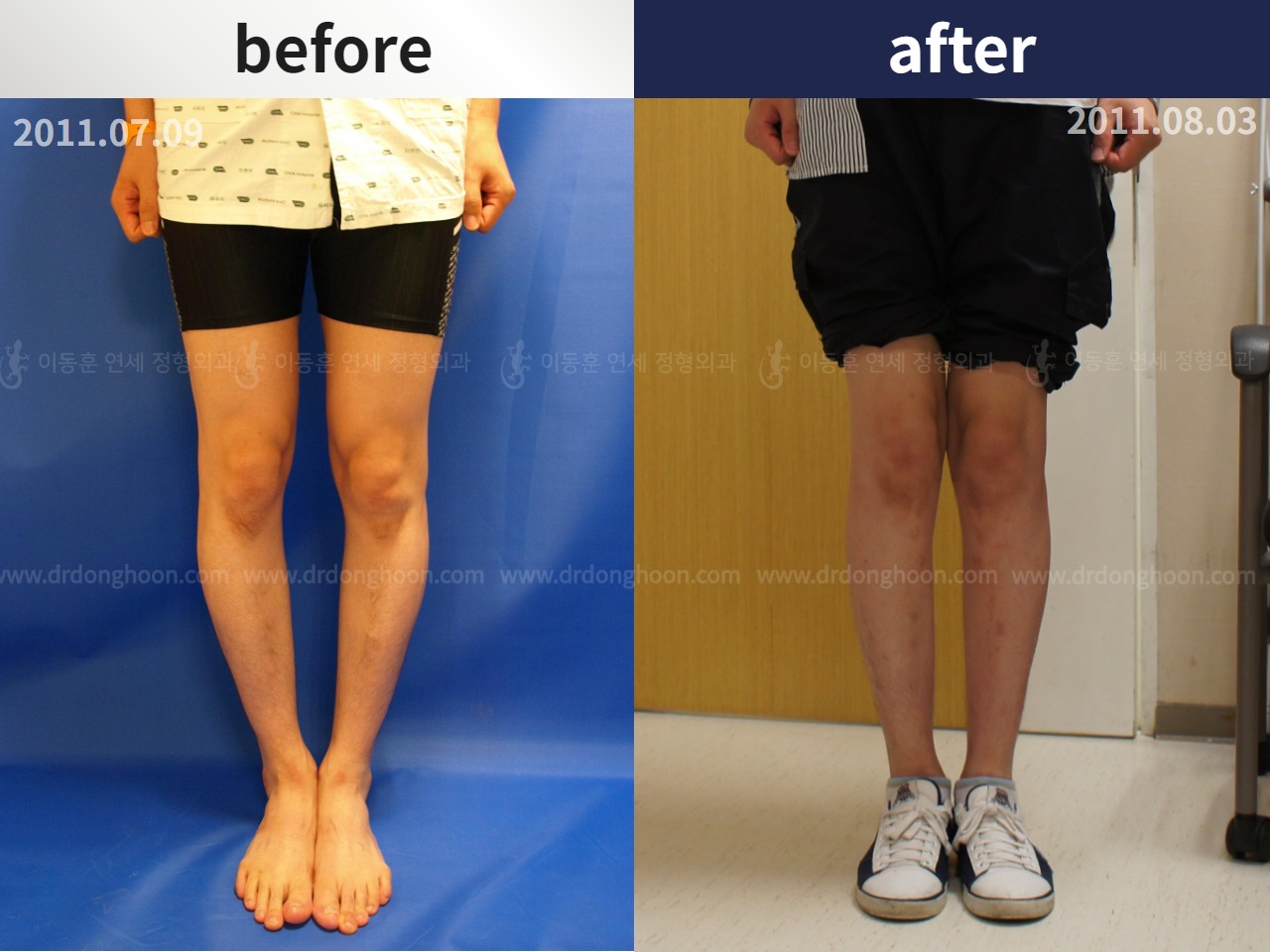 Before and after adult bowlegs, case 4311108, image 1, Dr. Donghoon institute (DALRI)