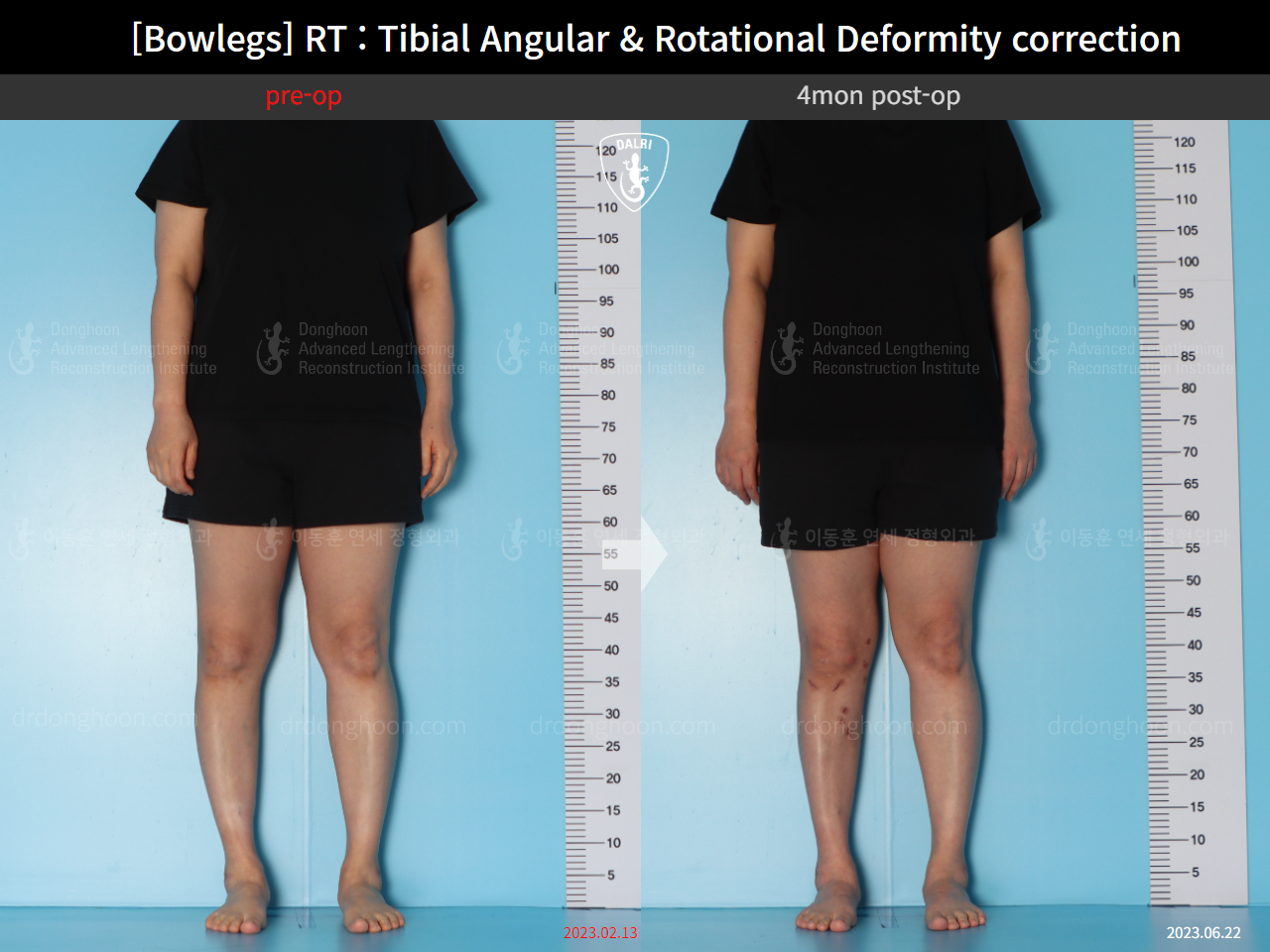 Before and after adult bowlegs, case 15741874, image 3, Dr. Donghoon institute (DALRI)