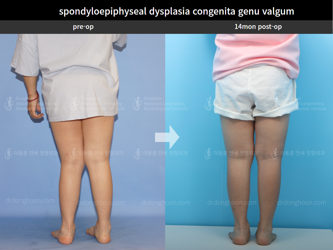 Before and after adult knock knees, case 8130481, image 2, Dr. Donghoon institute (DALRI)