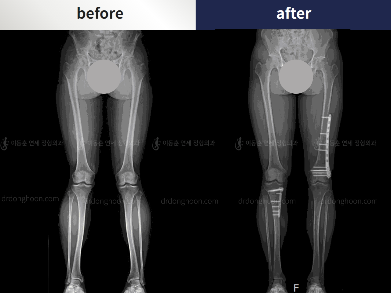 Before and after adult knock knees, case 5385795, image 3, Dr. Donghoon institute (DALRI)