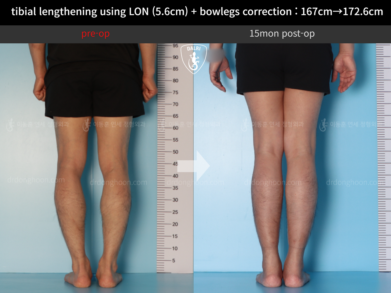 Before and after cll + deformity correction, case 12804946, image 6, Dr. Donghoon institute (DALRI)