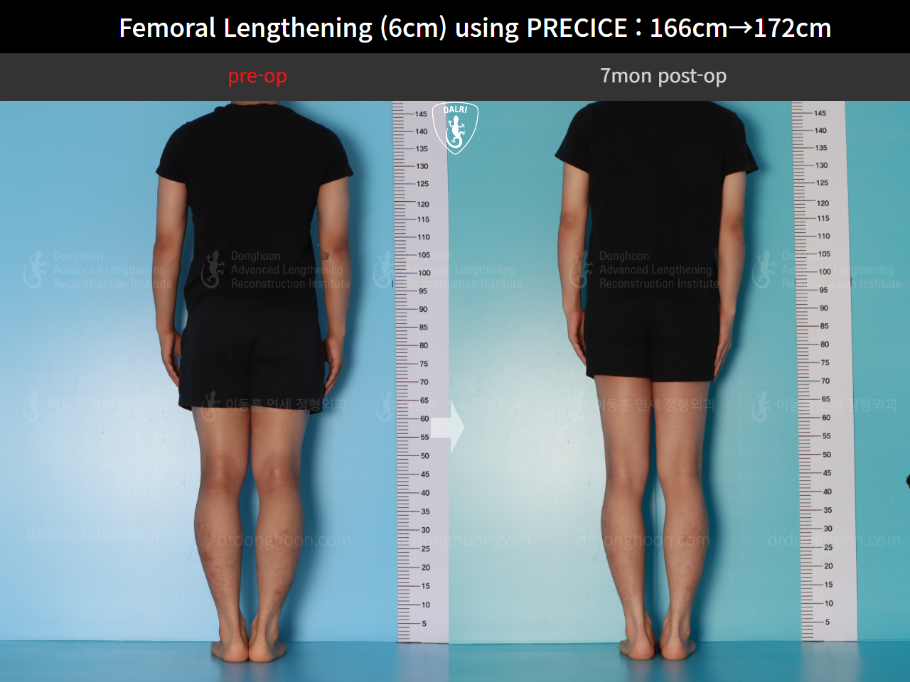 Before and after cll precice, case 17579263, image 2, Dr. Donghoon institute (DALRI)