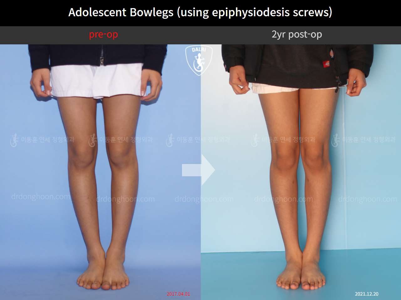 Before and after paediatric & adolescent bowlegs, case 4585777, image 3, Dr. Donghoon institute (DALRI)