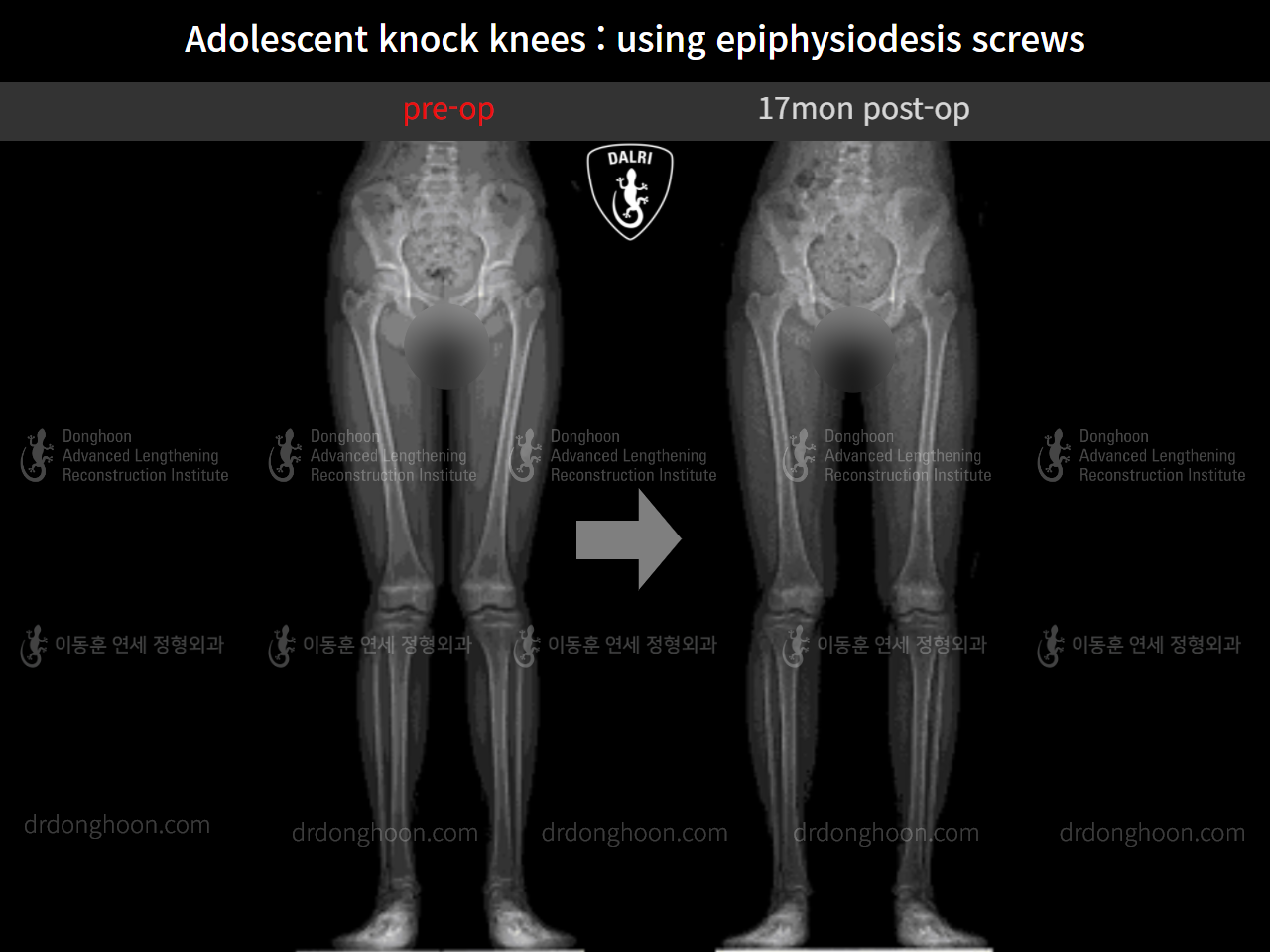 Before and after paediatric & adolescent knock knees, case 10451470, image 7, Dr. Donghoon institute (DALRI)