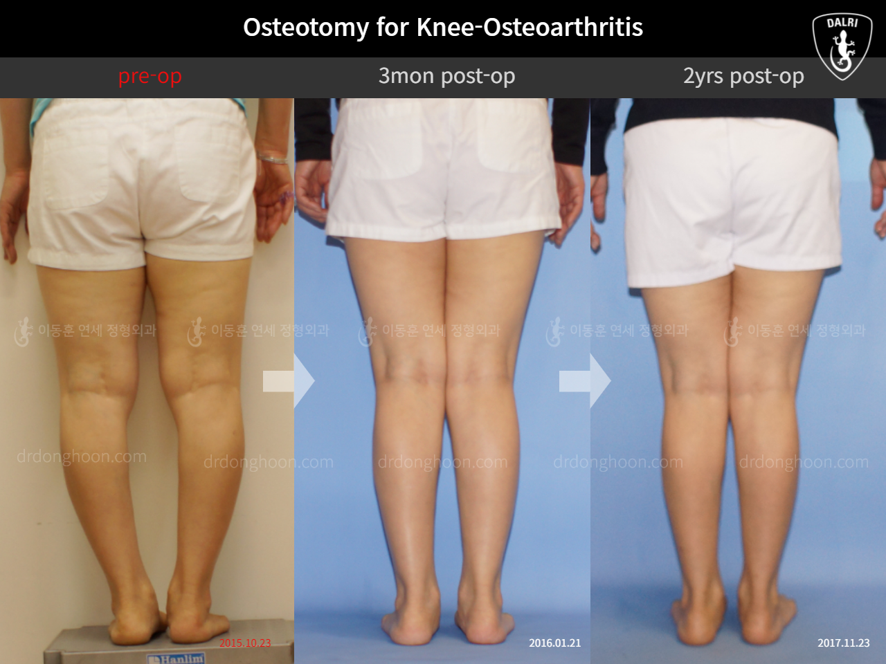 Before and after osteotomy for knee osteoarthritis, case 11785573, image 4, Dr. Donghoon institute (DALRI)