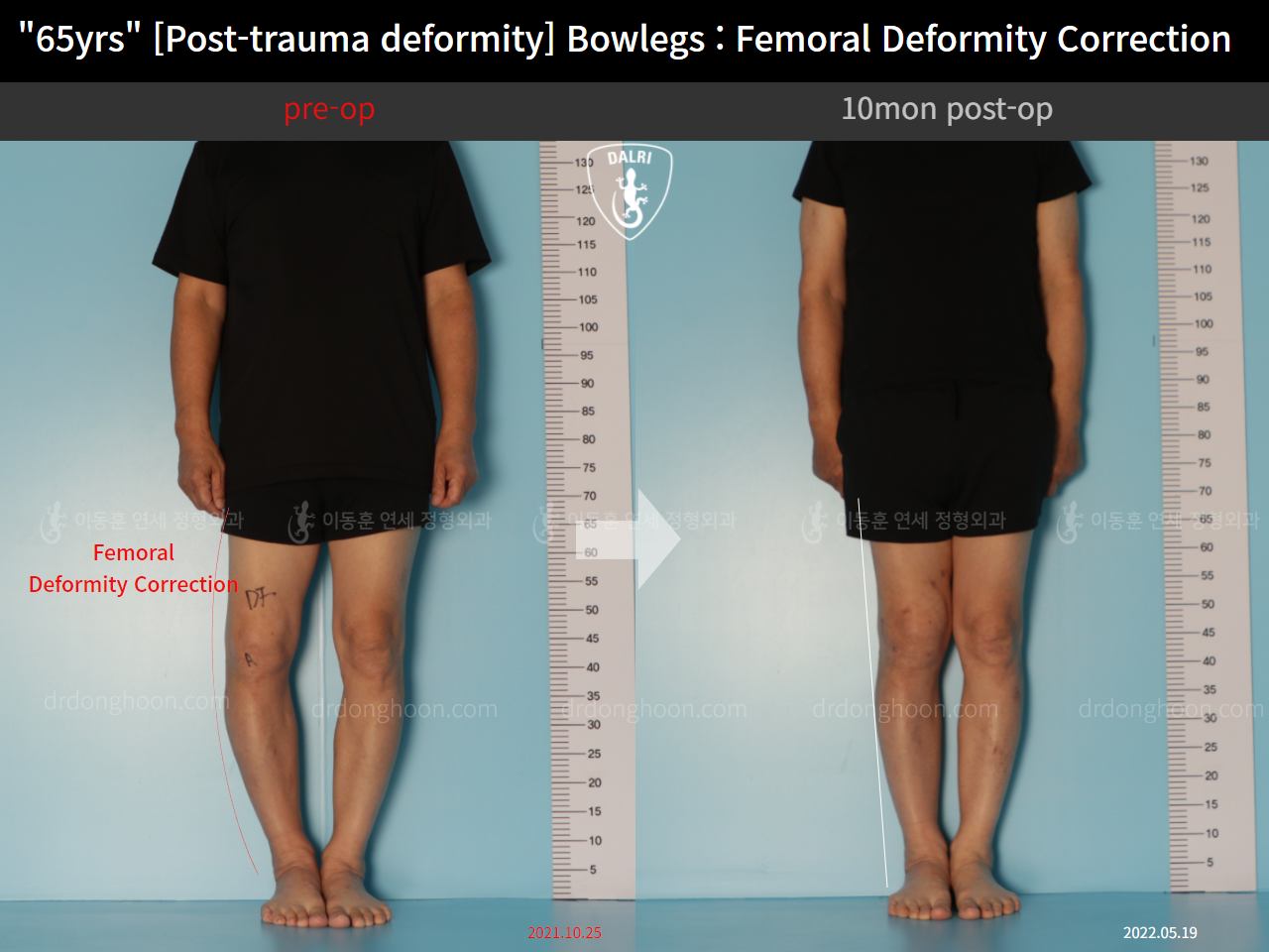 Before and after osteotomy for knee osteoarthritis, case 11675321, image 1, Dr. Donghoon institute (DALRI)