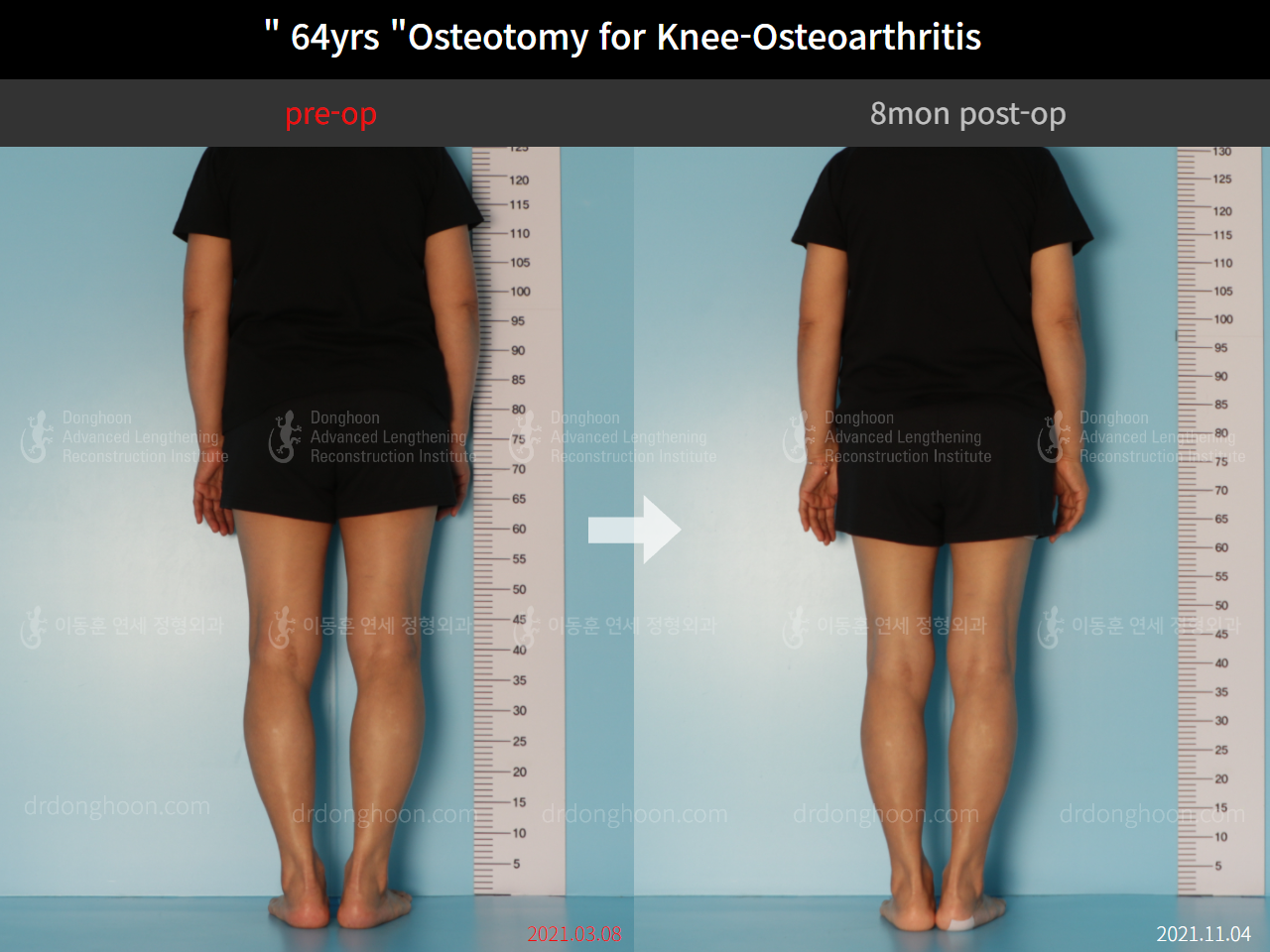 Before and after osteotomy for knee osteoarthritis, case 8761106, image 2, Dr. Donghoon institute (DALRI)