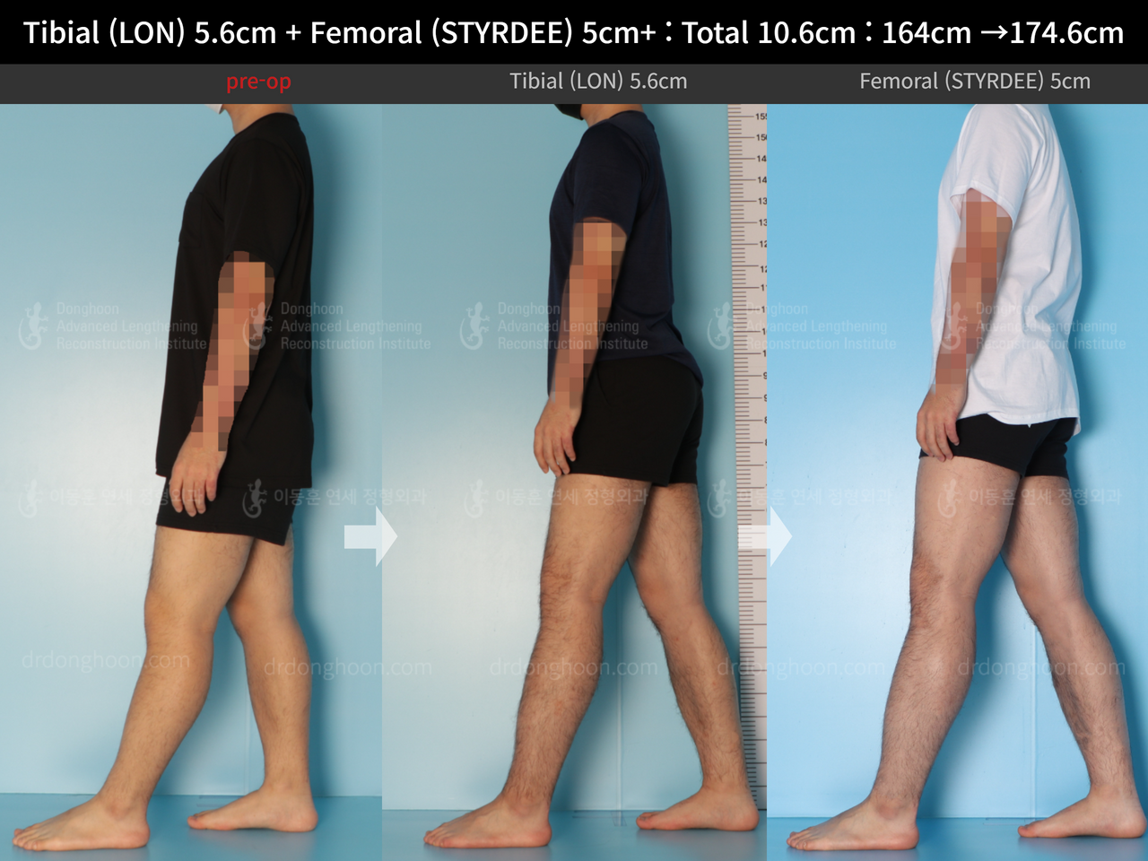 Before and after cll precice, case 13942494, image 4, Dr. Donghoon institute (DALRI)