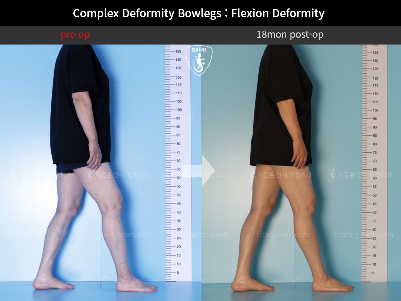 Before and after osteotomy for knee osteoarthritis, case 11337460, image 6, Dr. Donghoon institute (DALRI)