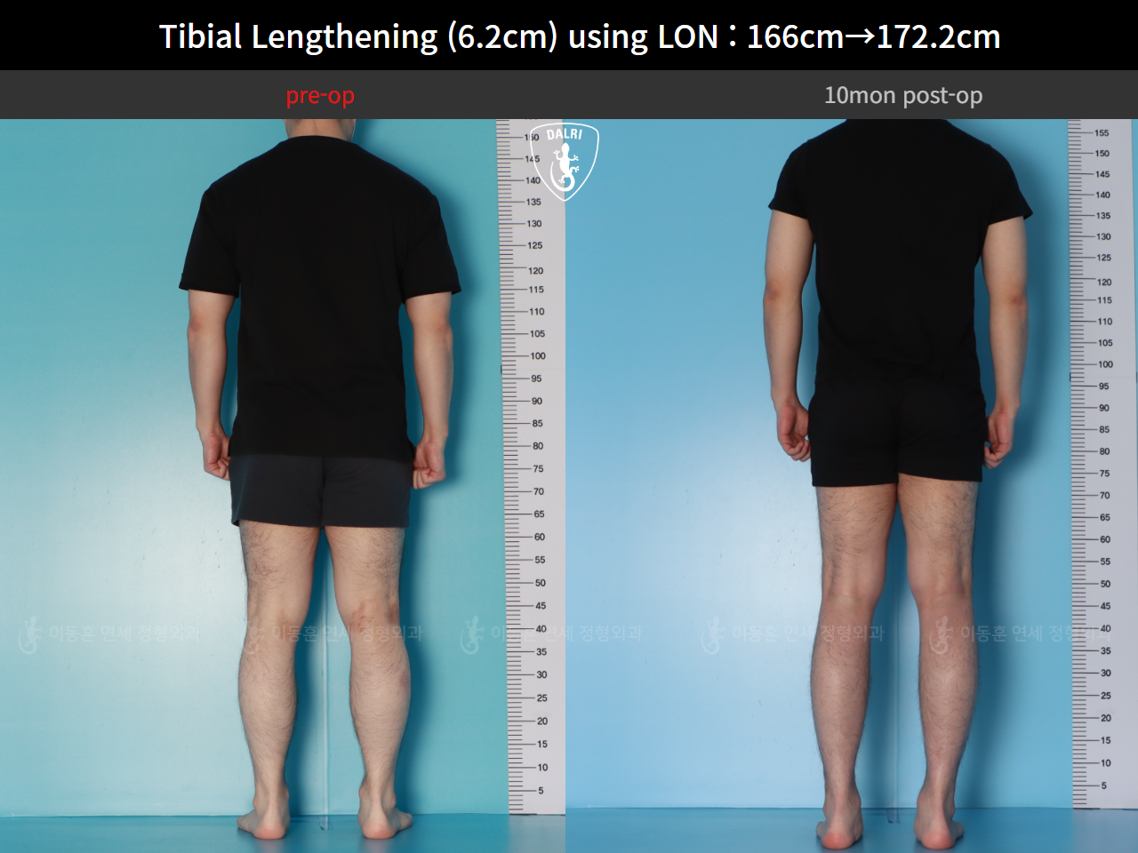 Before and after cll lon, case 128591201, image 4, Dr. Donghoon institute (DALRI)