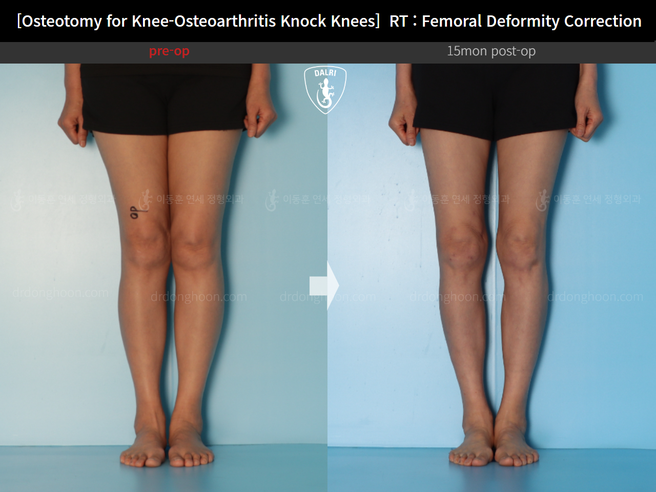 Before and after osteotomy for knee osteoarthritis, case 14462707, image 7, Dr. Donghoon institute (DALRI)