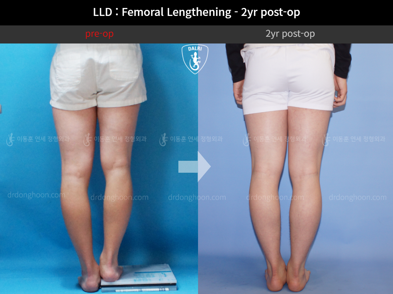 Before and after adult lld, case 4320322, image 4, Dr. Donghoon institute (DALRI)