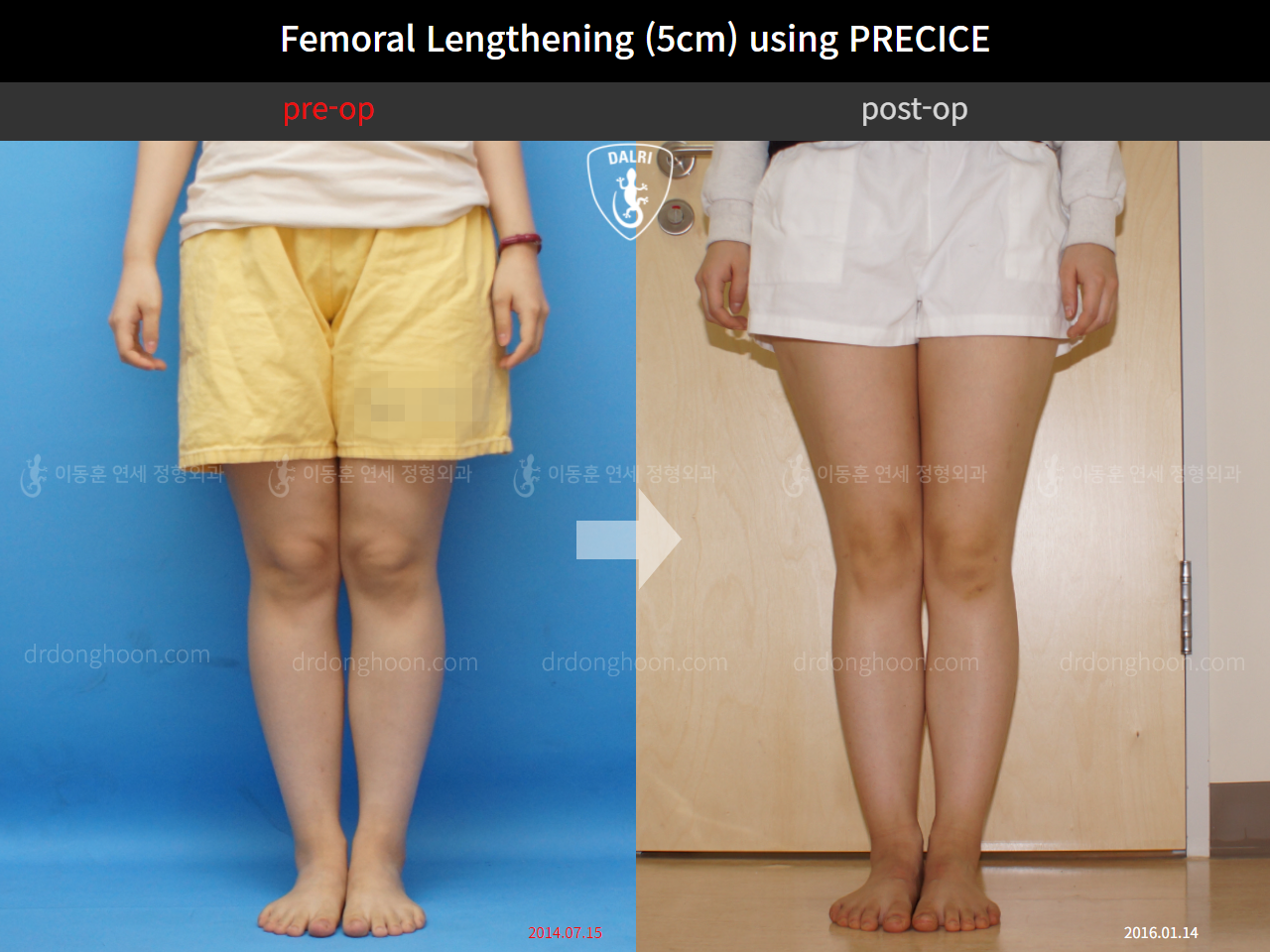Before and after cll precice, case 4323409, image 3, Dr. Donghoon institute (DALRI)