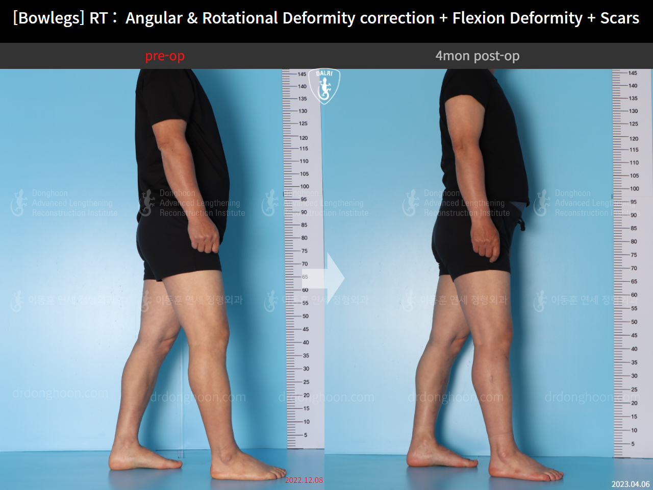 Before and after adult bowlegs, case 14701830, image 4, Dr. Donghoon institute (DALRI)