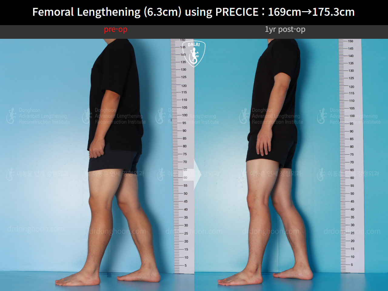 Before and after cll precice, case 16070058, image 7, Dr. Donghoon institute (DALRI)