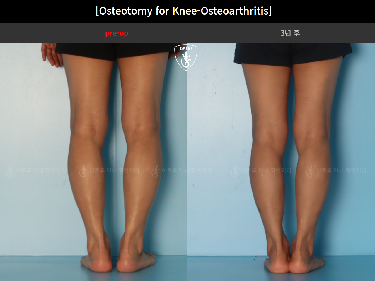 Before and after osteotomy for knee osteoarthritis, case 85842641, image 8, Dr. Donghoon institute (DALRI)