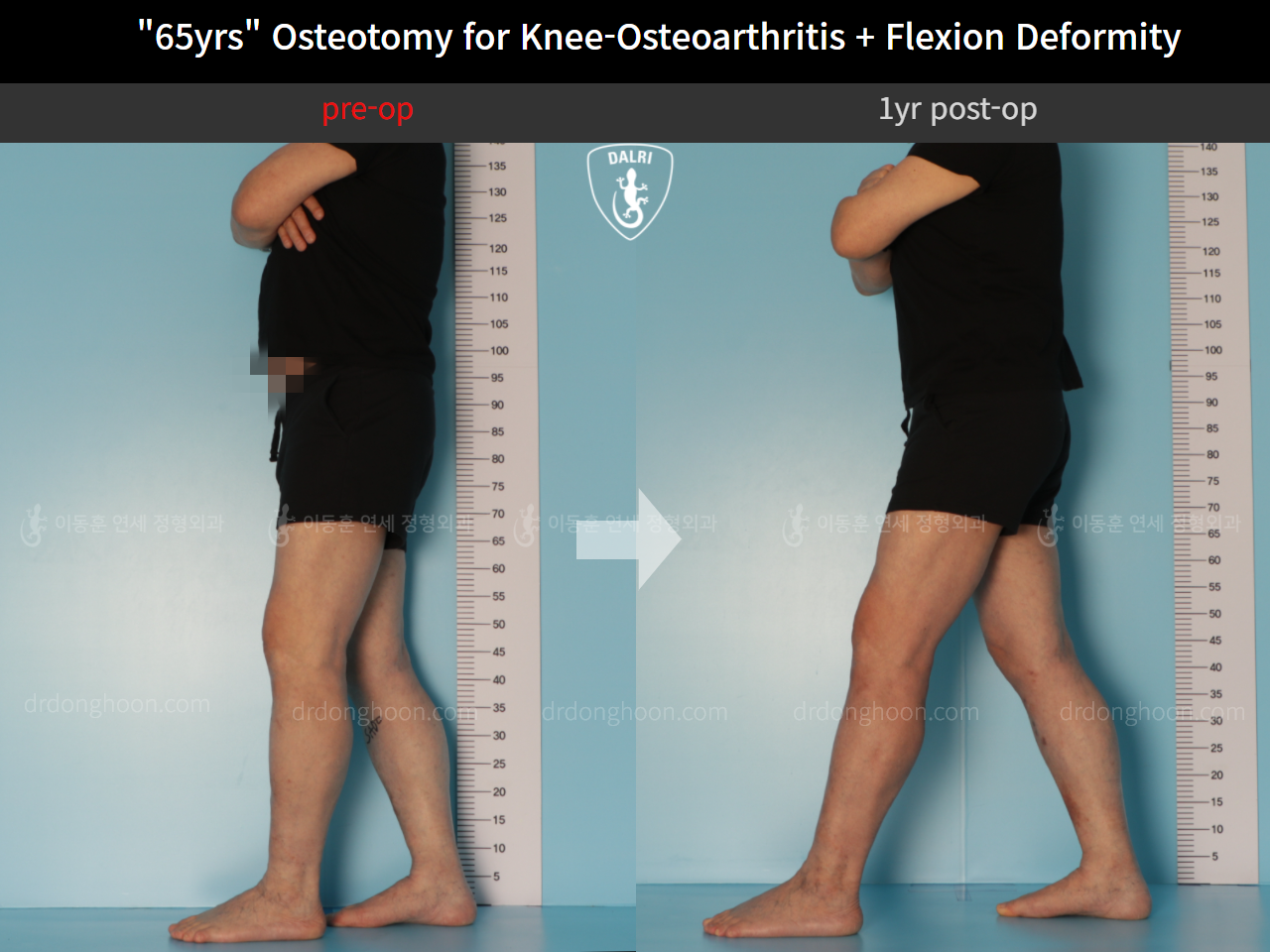 Before and after osteotomy for knee osteoarthritis, case 10742820, image 6, Dr. Donghoon institute (DALRI)