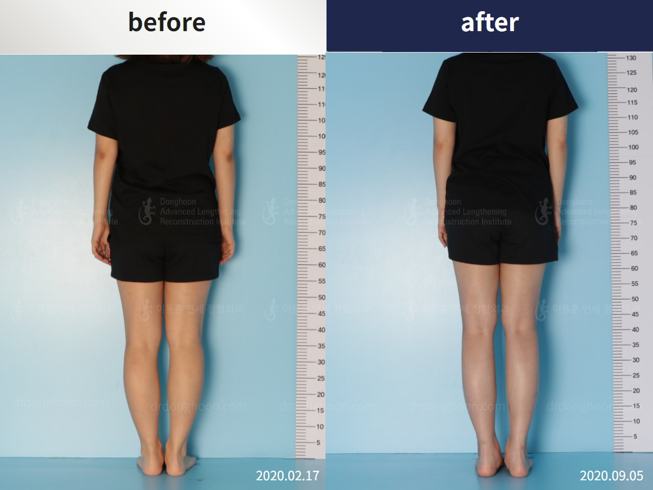 Before and after cll lon, case 4860839, image 3, Dr. Donghoon institute (DALRI)