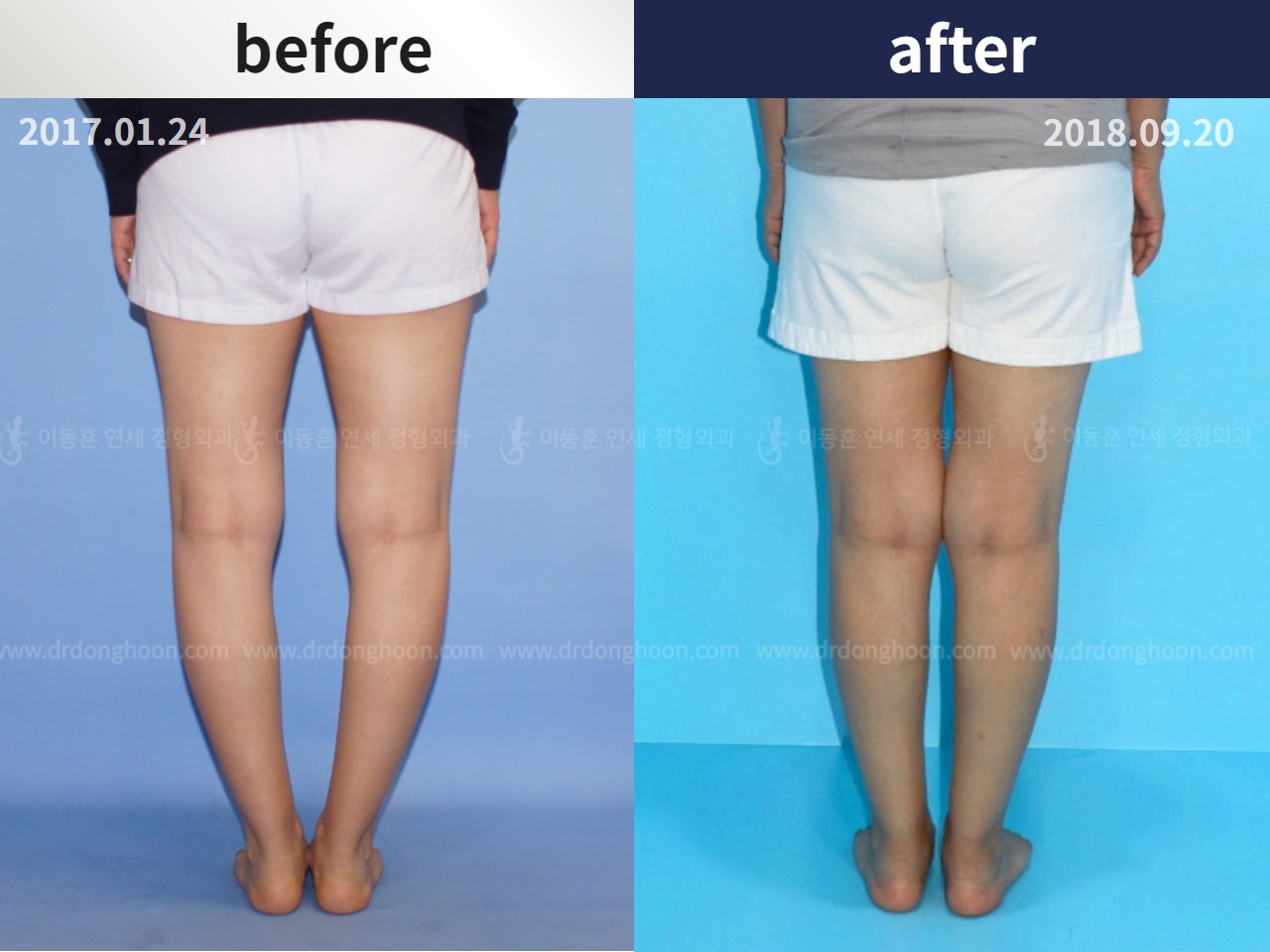 Before and after osteotomy for knee osteoarthritis, case 4306421, image 2, Dr. Donghoon institute (DALRI)