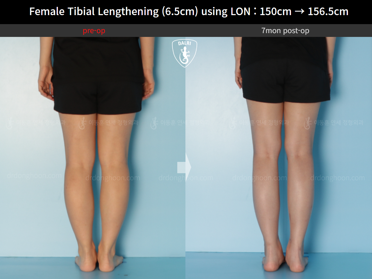 Before and after cll lon, case 16061220, image 6, Dr. Donghoon institute (DALRI)