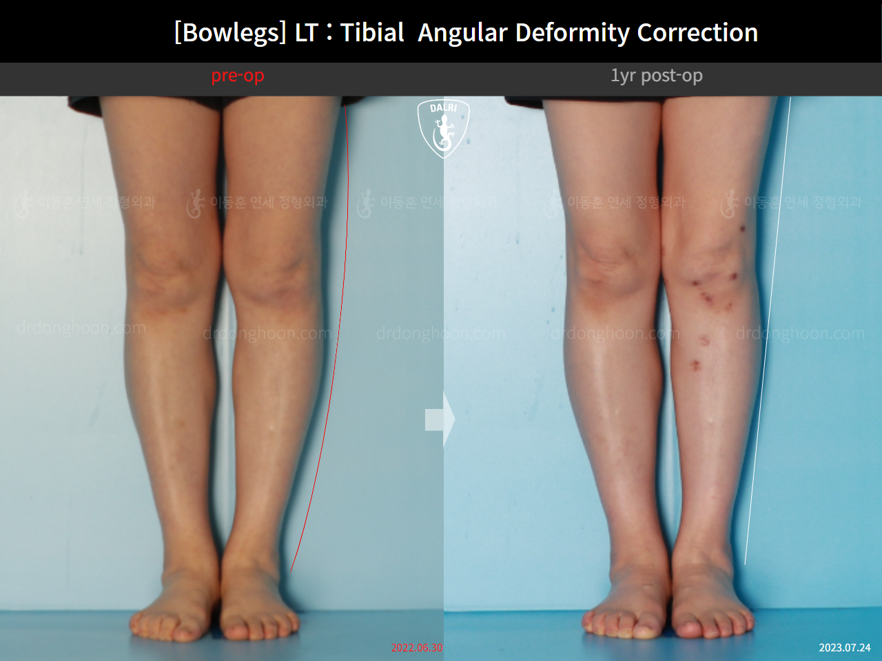 Before and after adult bowlegs, case 16787003, image 6, Dr. Donghoon institute (DALRI)