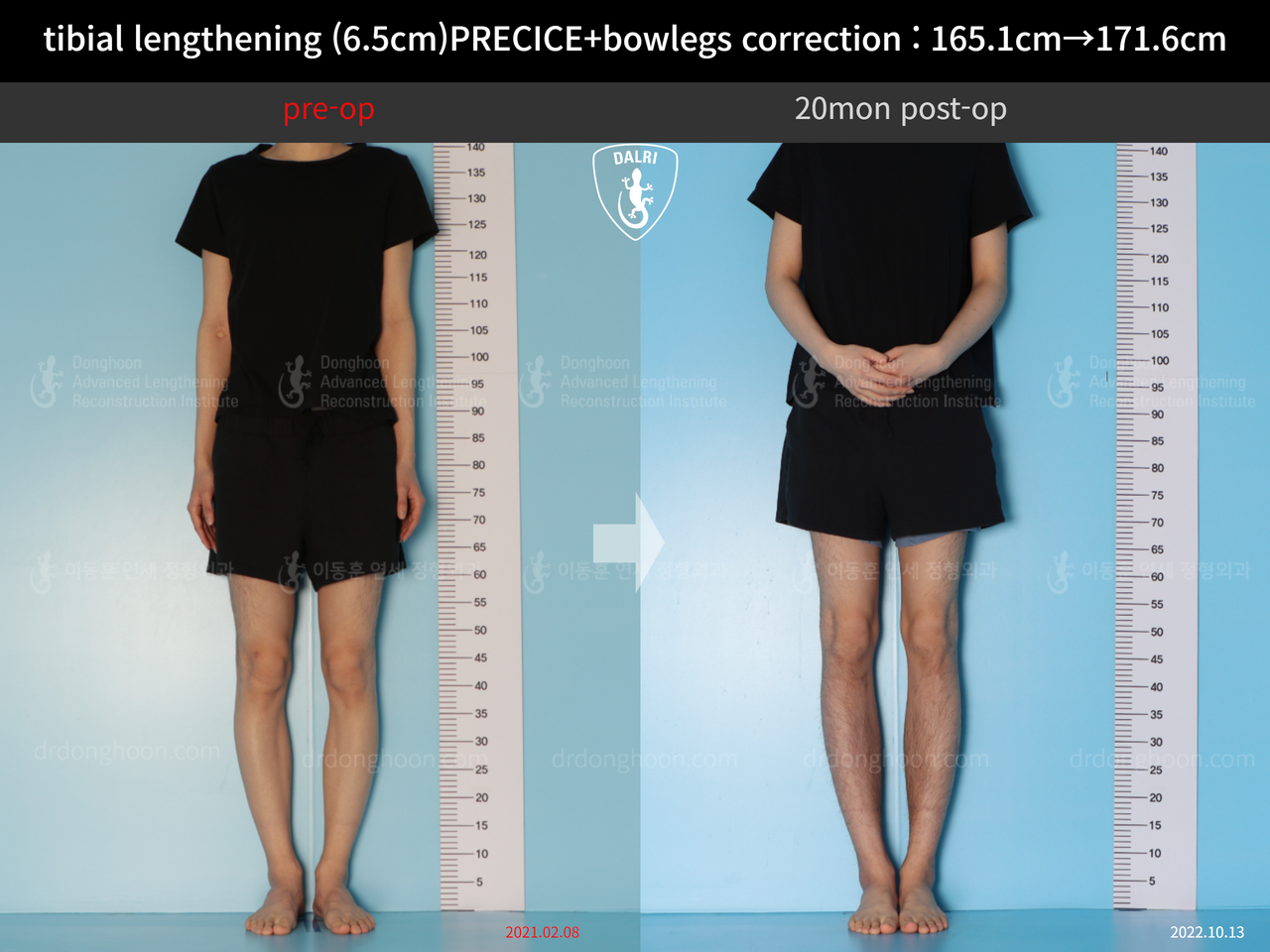 Before and after cll + deformity correction, case 13168253, image 3, Dr. Donghoon institute (DALRI)
