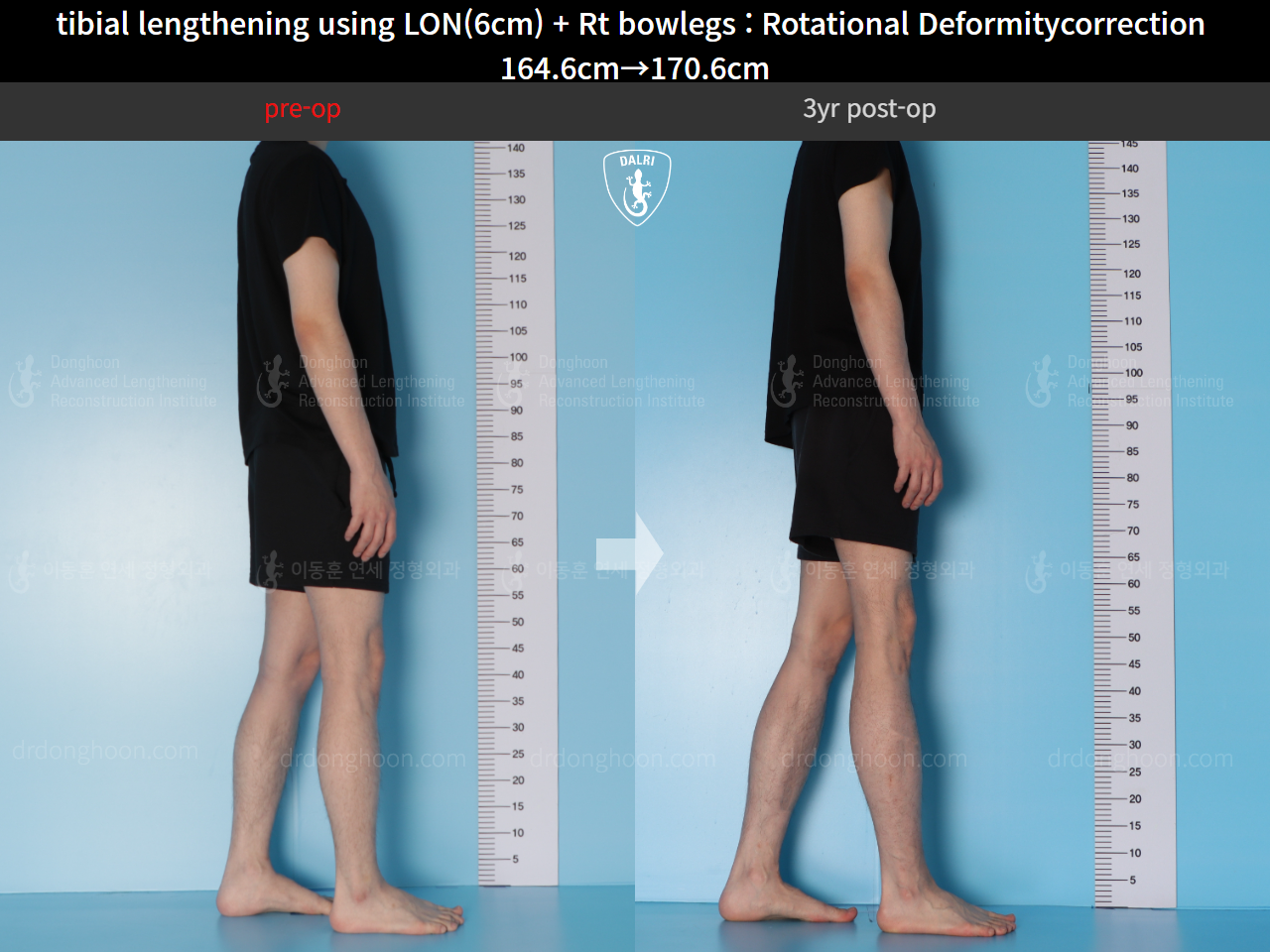 Before and after cll + deformity correction, case 15347322, image 4, Dr. Donghoon institute (DALRI)