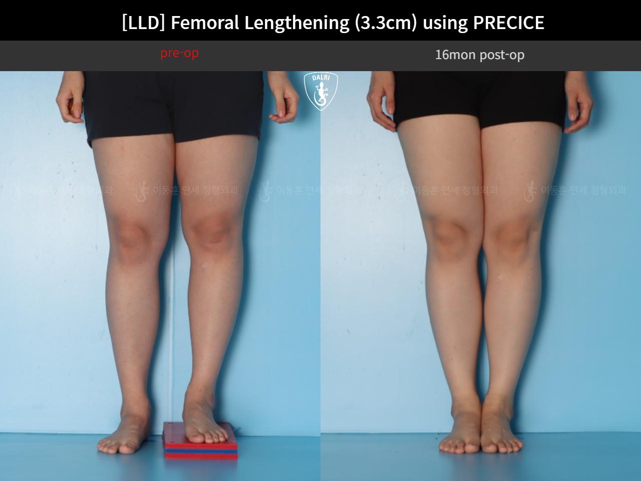 Before and after adult lld, case 125639660, image 5, Dr. Donghoon institute (DALRI)