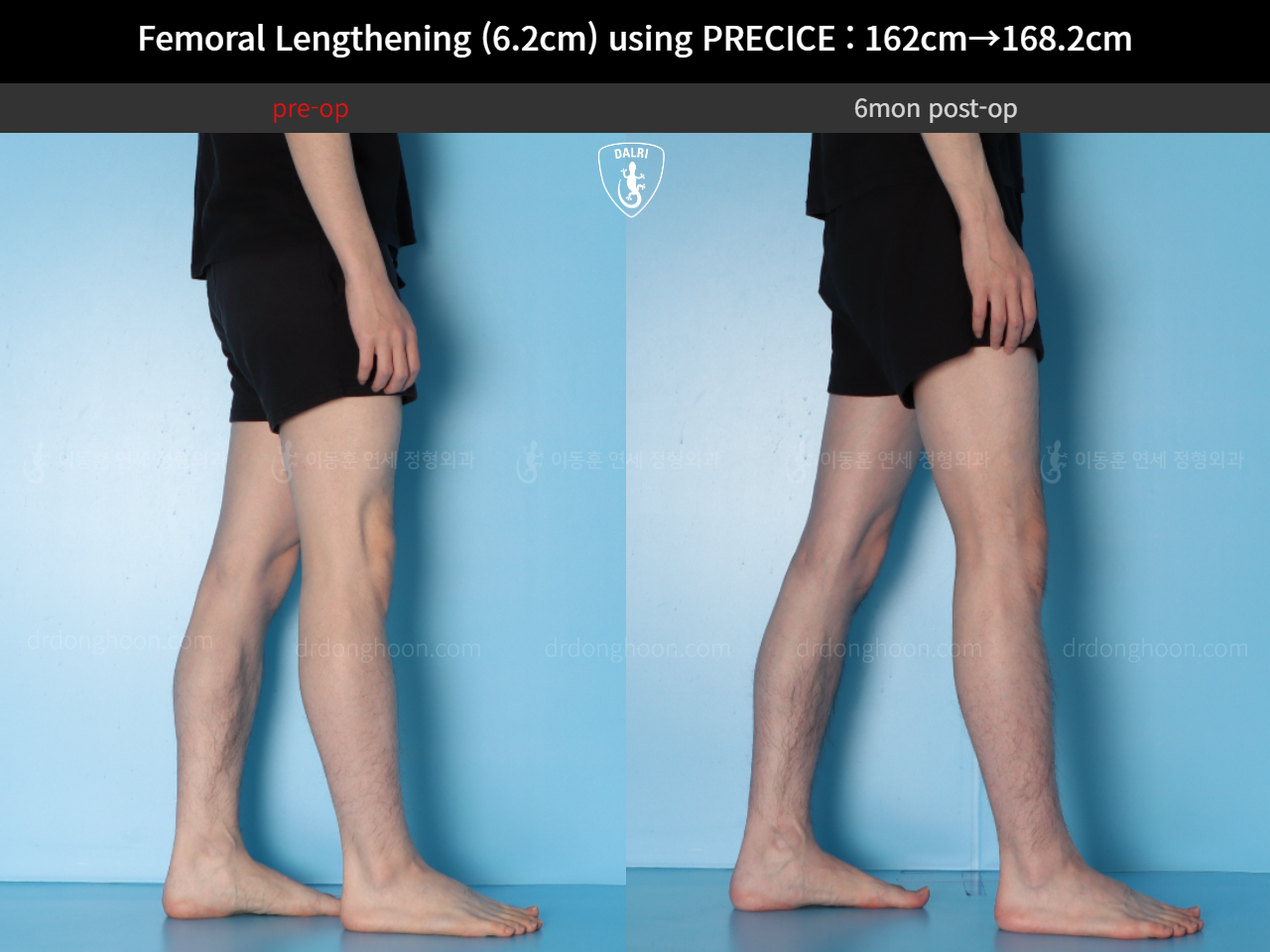 Before and after cll precice, case 15393865, image 11, Dr. Donghoon institute (DALRI)