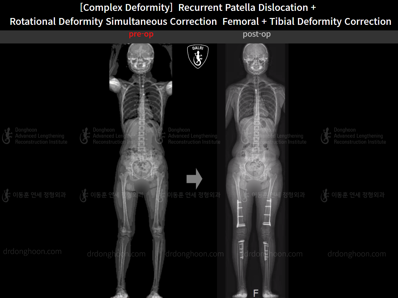 Before and after recurrent patella dislocation, case 16298897, image 8, Dr. Donghoon institute (DALRI)
