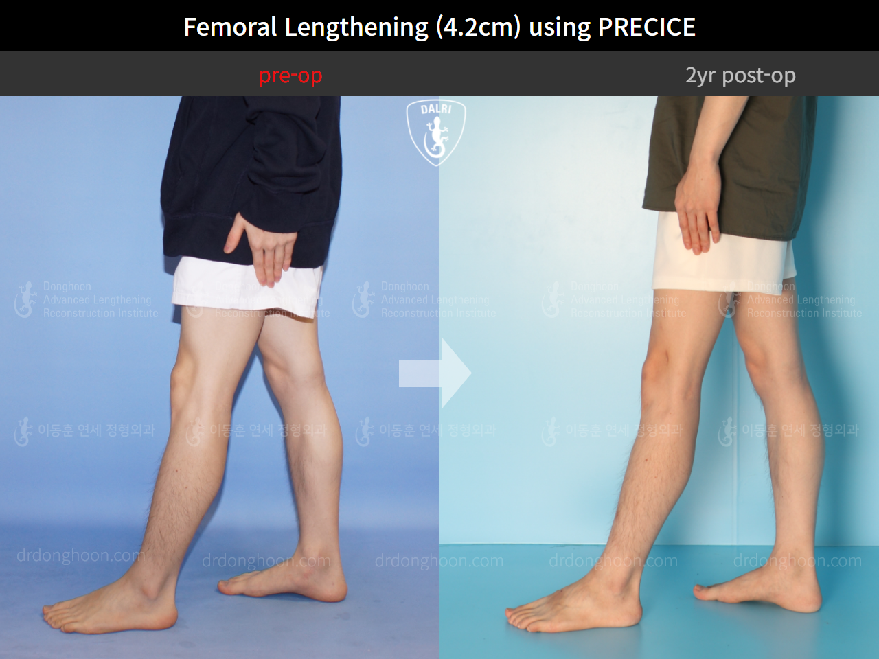 Before and after cll precice, case 4323396, image 8, Dr. Donghoon institute (DALRI)