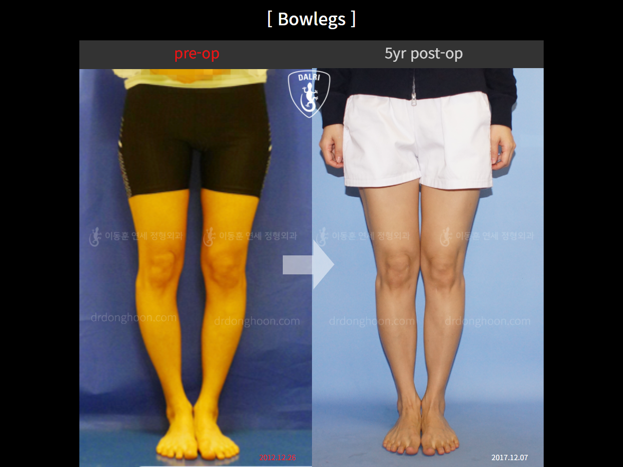 Before and after adult bowlegs, case 4311008, image 2, Dr. Donghoon institute (DALRI)