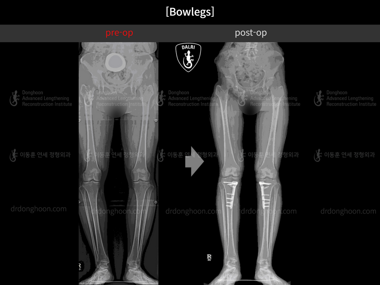 Before and after adult bowlegs, case 4311016, image 5, Dr. Donghoon institute (DALRI)