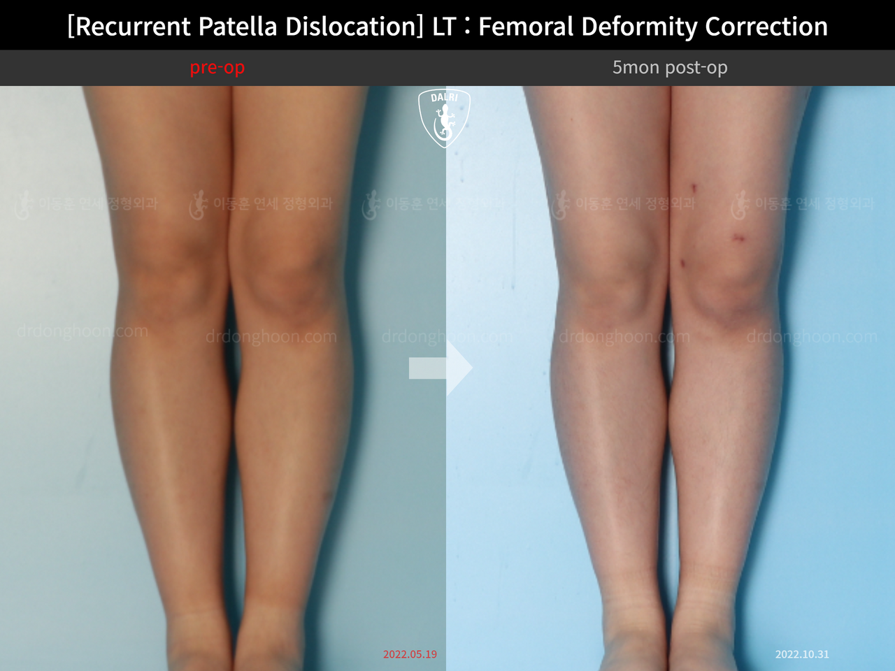 Before and after recurrent patella dislocation, case 13337596, image 5, Dr. Donghoon institute (DALRI)