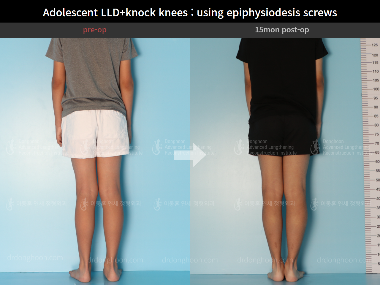 Before and after paediatric & adolescent knock knees, case 8413324, image 2, Dr. Donghoon institute (DALRI)
