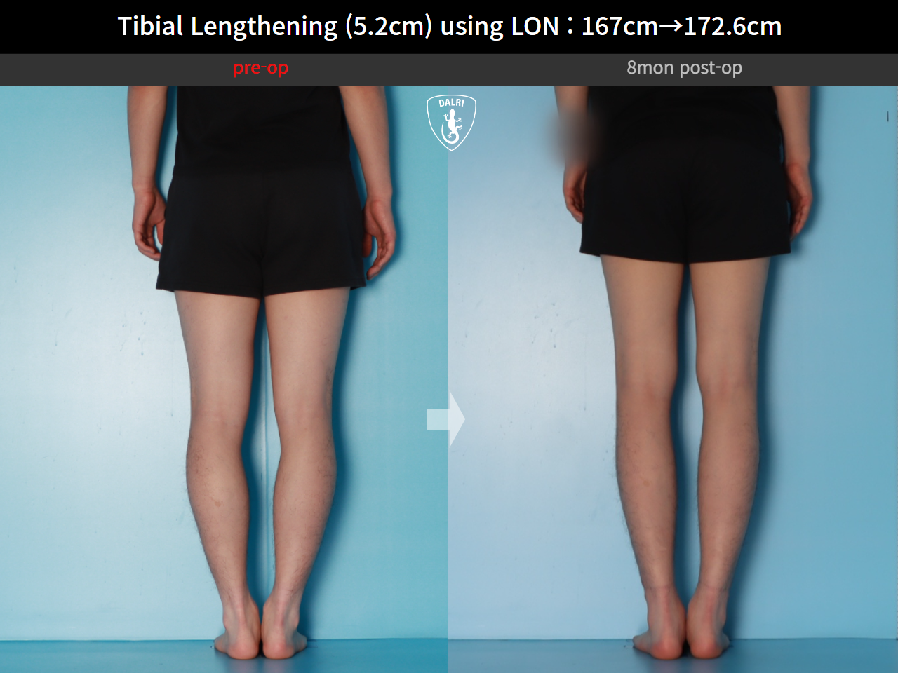 Before and after cll lon, case 29672720, image 8, Dr. Donghoon institute (DALRI)
