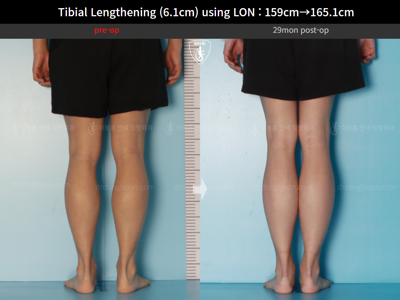 Before and after cll lon, case 16723424, image 8, Dr. Donghoon institute (DALRI)