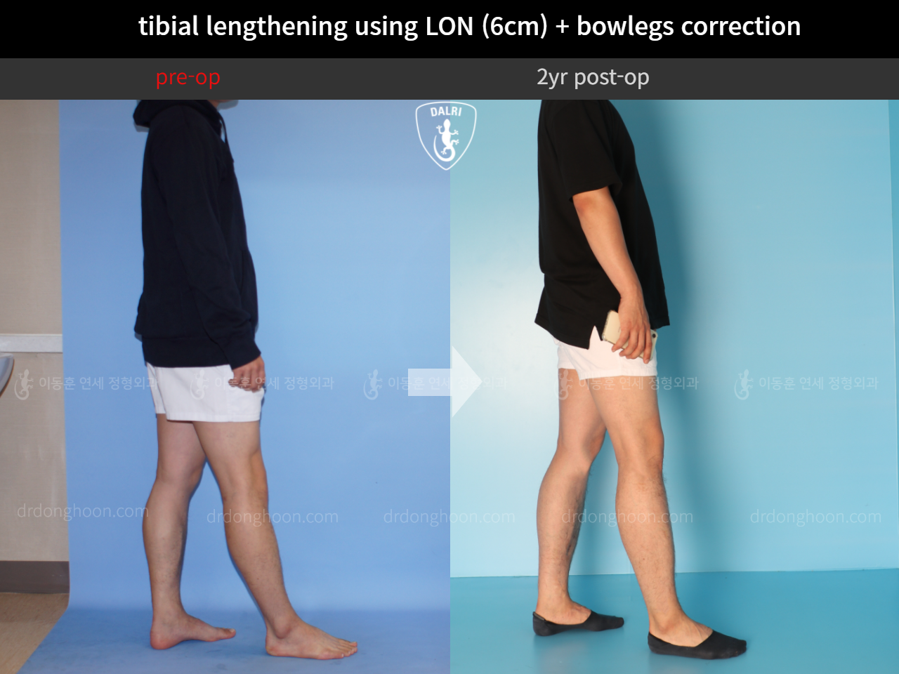 Before and after cll + deformity correction, case 4323155, image 4, Dr. Donghoon institute (DALRI)
