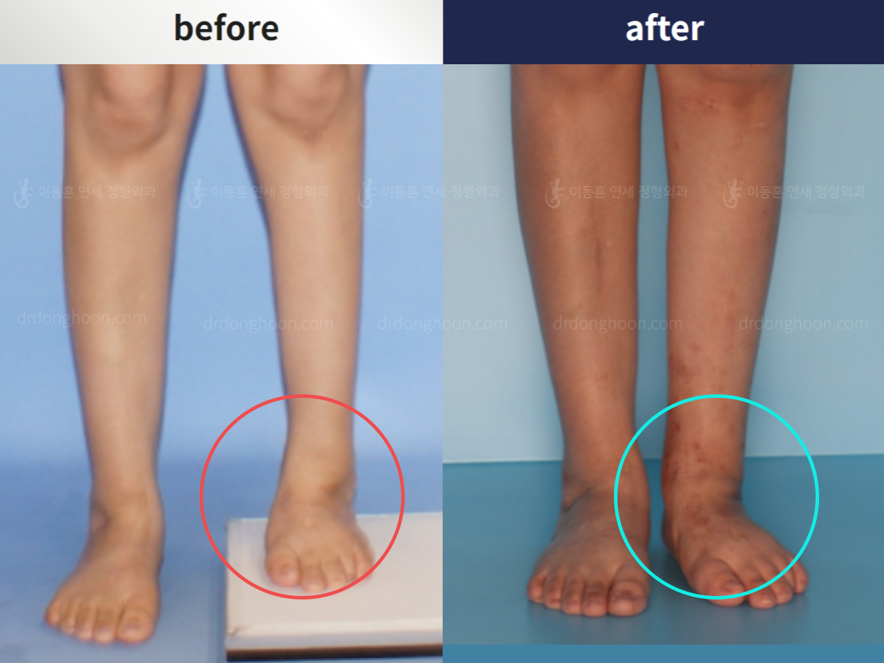 Before and after foot & ankle deformity, case 4248045, image 2, Dr. Donghoon institute (DALRI)
