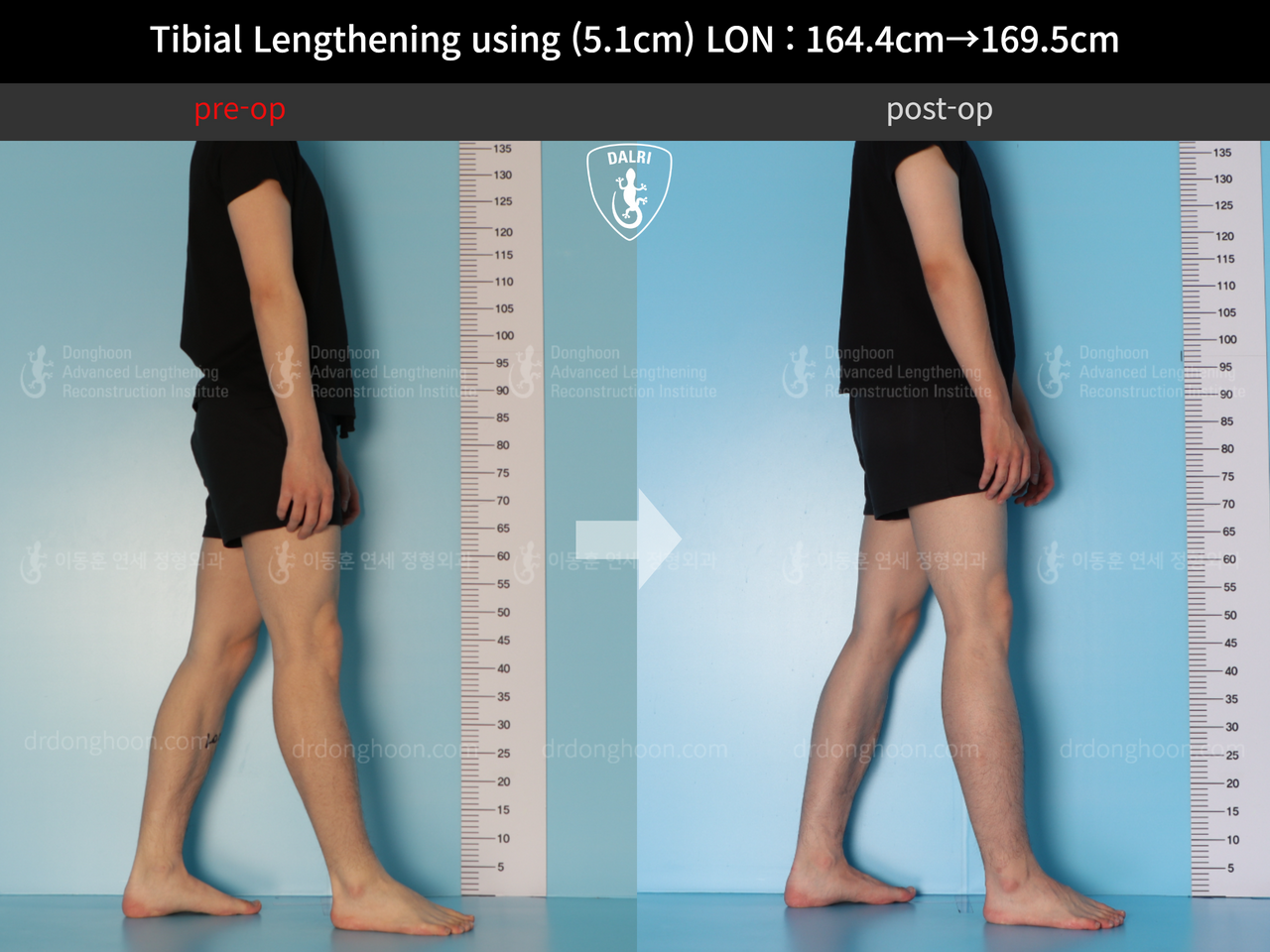Before and after cll lon, case 12653375, image 3, Dr. Donghoon institute (DALRI)