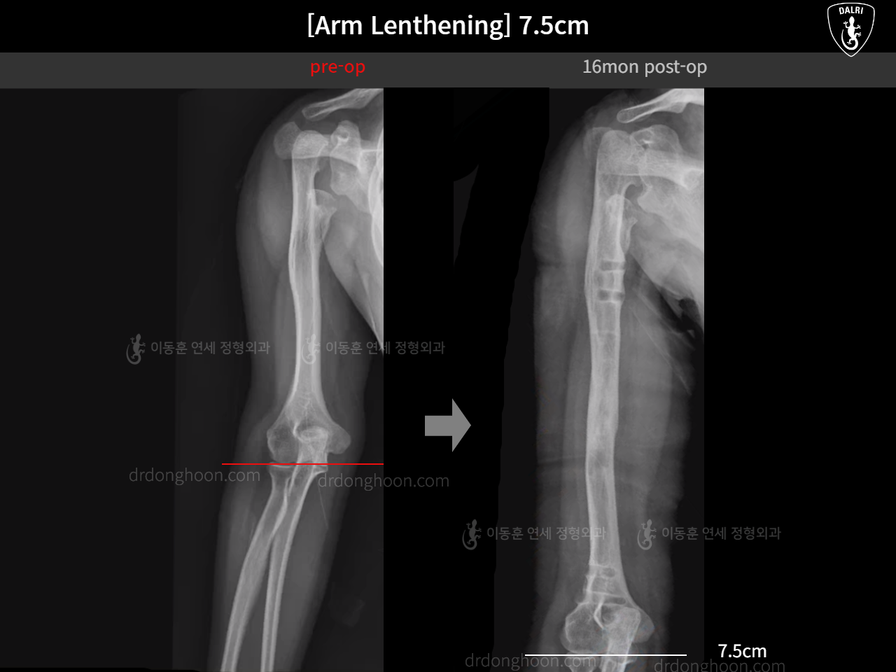 Before and after arm lengthening, case 16280690, image 2, Dr. Donghoon institute (DALRI)